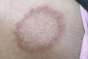 Lire la suite à propos de l’article Dermatophilose sexuellement transmissible : une infection cutanée rare inquiète les médecins entre Barcelone, Lyon et Paris